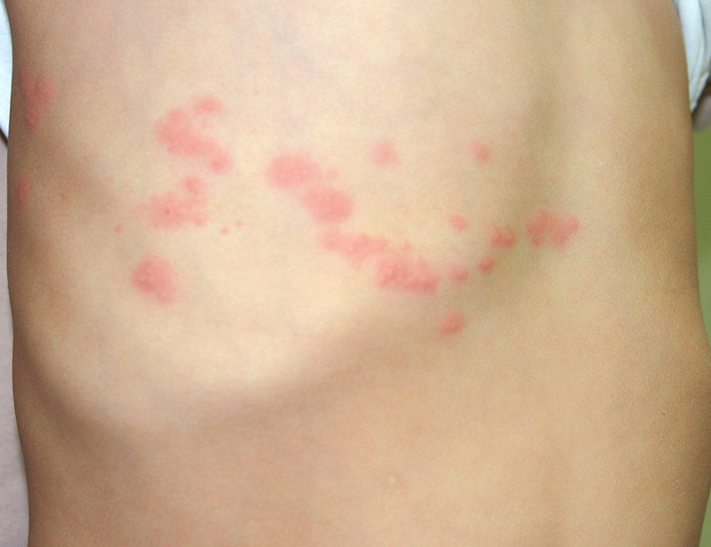 症状 ネズミ アレルギー ハリネズミによるアレルギーの症状とは？針が刺さると喘息になる？